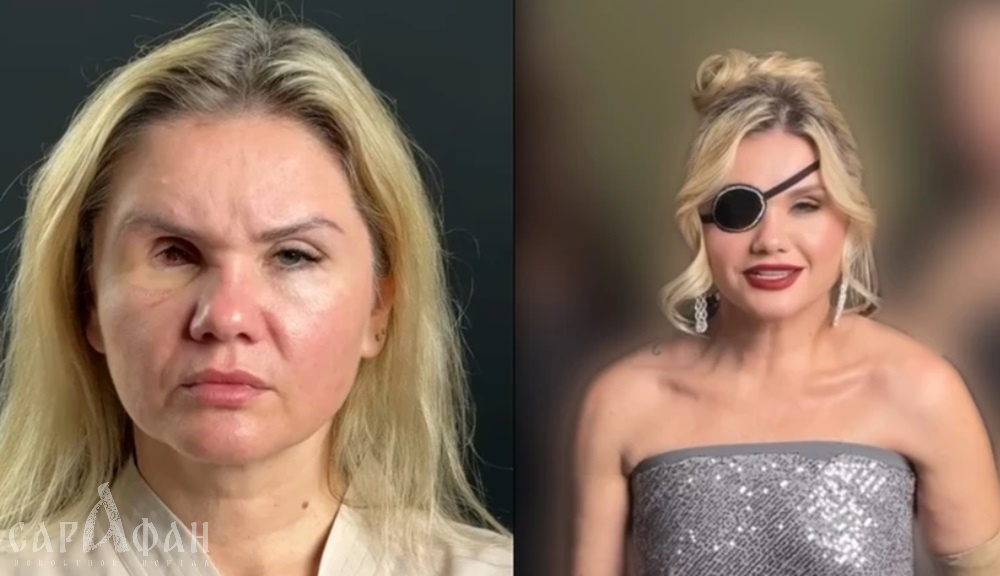 «Я напугана»: сочинка с выколотым глазом рассказала, что ее агрессивный любовник ушел на СВО