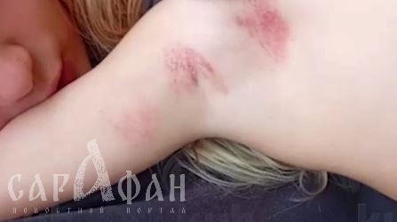 «Гематомы и ссадины, запеченная кровь»: в Краснодаре у малышки диагностировали перелом ключицы после посещения детского сада