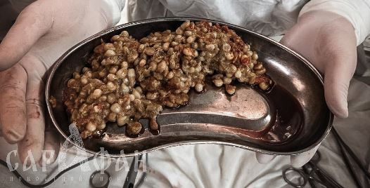 Корчилась от боли, хватаясь за живот: в Краснодаре хирурги не поверили глазам, когда добрались до источника диких мучений женщины с ожирением